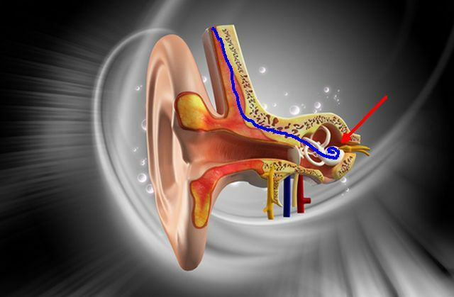 cochlearis-implant2