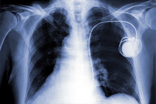 pacemaker-X-ray